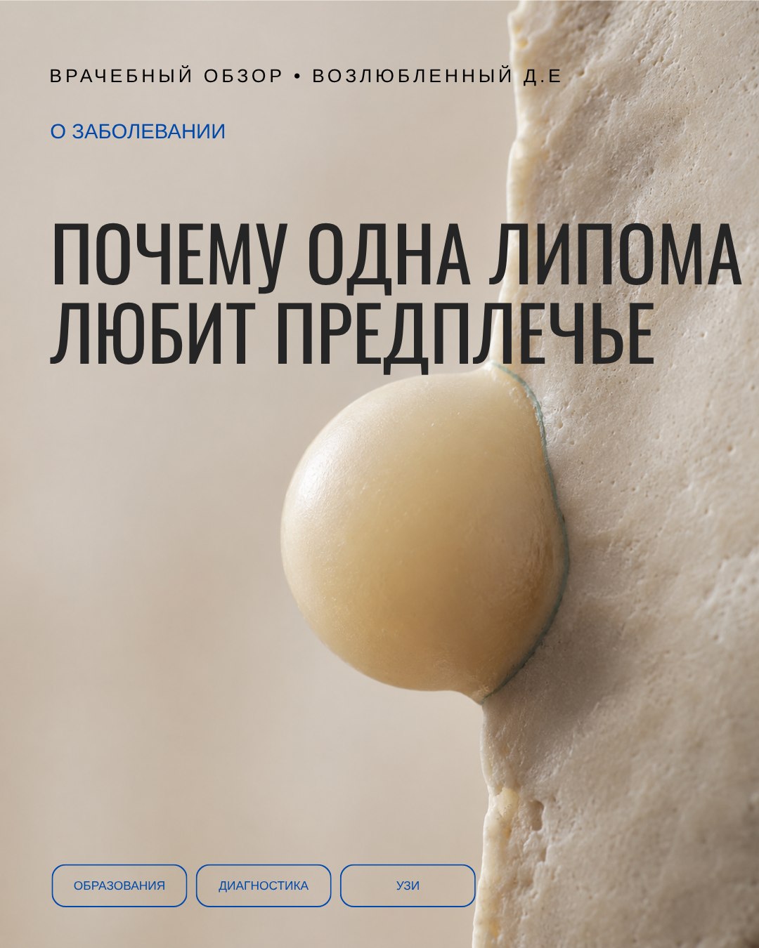 Обычная липома на предплечье — не так уж часто. А вот один её подвид — почти нигде, кроме предплечья